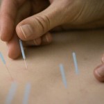 Acupuncture